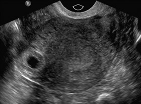 Ectopic Pregnancy